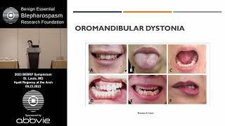 Treatment of Torticollis and Oromandibular Dystonia - Ghazala Hayat, MD