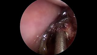 Professional Removal of GOOEY Boogers in Nose