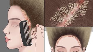 ASMR Animation | Satisfying Scalp Treatment | Big Flakes Dandruff Removal! | Meng’s Stop Motion