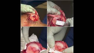 Surgery + Orthobiologics (PRP)  For A Patellar Dislocation With A Large Chondral Defect