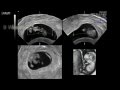 Baby Ultrasound early pregnancy 5,6,7,8,9 weeks 3D Baby Ultrasound early pregnancy 5,6,7,8,9 weeks 3D
