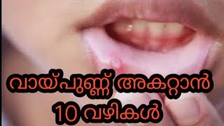 വായ്പുണ്ണ് മാറാൻ 10 വഴികൾ