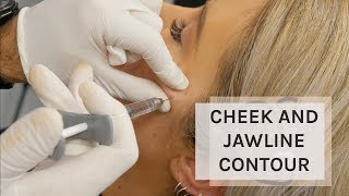 VIVA Skin Clinics | Cheek and Jawline Contour | Love Island Look | Non Surgical Facelift