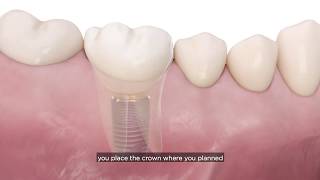 Incorporating a digital implant workflow into practice