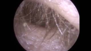 227 - 10 year old Cotton Bud ( Q-tip ) Extracted from Ear Canal to Restore Hearing - Mr N Raithatha