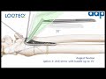 LOQTEQ® VA Volar Distal Radius Plate 2.5 - Surgical Technique