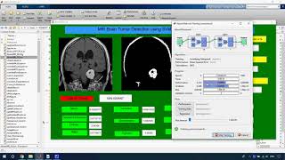 Brain Tumor Detection Using SVM Classifier