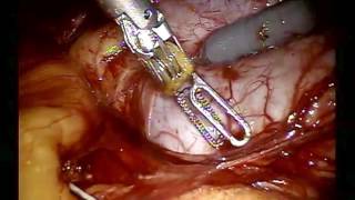 Robotic Pyeloplasty 2017