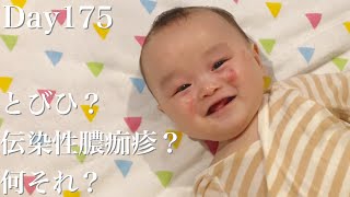 【生後5ヶ月】とびひ？伝染性膿痂疹？乳児湿疹。