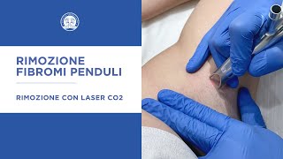 Laser CO2 per rimozione fibromi penduli