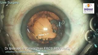 Live surgery from Nandadeep Eye Hospital Dr Sourabh Patwardhan