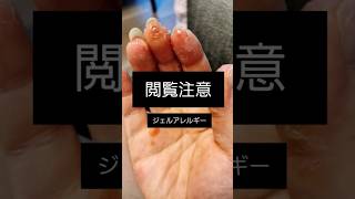 今気をつけますか？一生後悔しますか？ 対策動画なども出していきますのでチャンネル登録してね#ジェルネイル #アレルギー#ネイリスト#接触性皮膚炎#ネイル 検定#セルフネイル