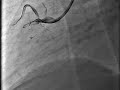 Chronic total occlusion of right coronary artery