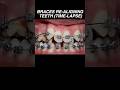 Time lapse of braces re-aligning crooked teeth #dentist #tooth #medical #health