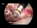 Arthroscopic Capsular Release for Frozen Shoulder