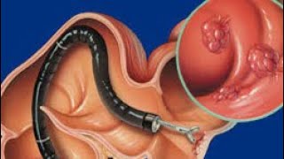 Mastering Biopsy in Colonoscopy and Endoscopy Procedure.