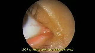 Дакриоцисториностомия  Dacriocystorhinostomy