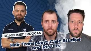 5100 GRAFTS HAIR TRANSPLANT CASE STUDY WITH DR.MEHMET ERDOGAN