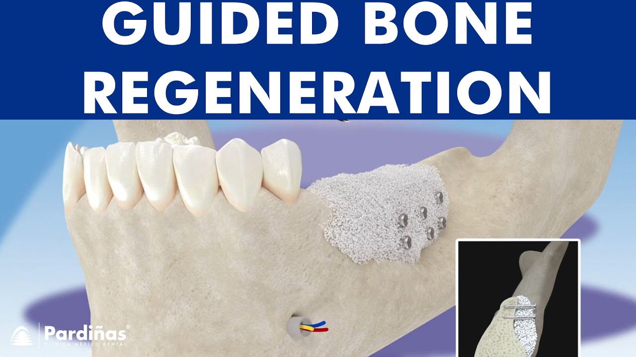 Guided Bone Regeneration - Bone Graft © - YouTube