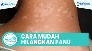 Cara Mudah Menghilangkan Panu pada Kulit, Di Antaranya Hindari Paparan Sinar UV