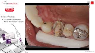 Dr. Kaminer on Traxodent - Clinical Case