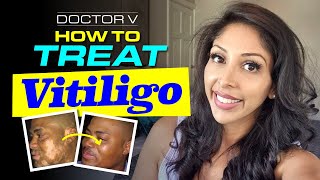 Doctor V - How To Treat Vitiligo | Skin Of Colour | Brown Or Black Skin