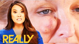 A Massive Cyst Is Blocking Off This Patient's Vision | Dr Pimple Popper