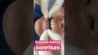 Braces #wow #impression #dental #dentist #youtubeshorts #subscribe #shorts #video #short