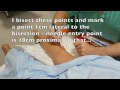 Popliteal block - posterior approach