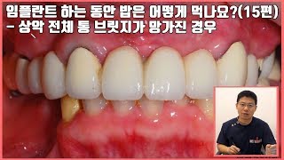 임플란트 하는 동안 밥은 어떻게 먹나요? (15편) - 상악 전체 통 브릿지가 망가진 경우