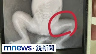 心疼！未滿月女嬰腿骨折　父母控「醫院疏失」｜#鏡新聞