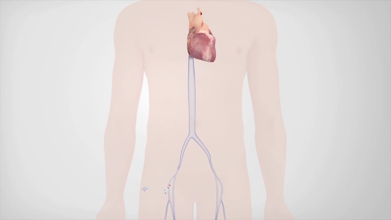 Radiofrequency Catheter Ablation - YouTube