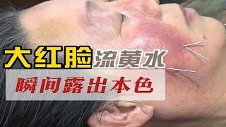 王瑞雪汉传针雕 大红脸流黄水，针雕一招瞬间露出本色  美雕 美容针灸 面部提升 私密针灸 中医美容