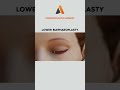 Lower Blepharoplasty | Answer Plastic Surgery #shorts #lowerblepharoplasty