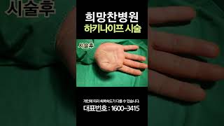 [#shorts] 엄지손가락이 굳은 것처럼 안 펴져요.. I can't straighten my thumb like it's hardened.. #비수술치료