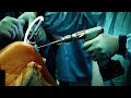 ACL Reconstruction by Answorth A. Allen, MD | Preview