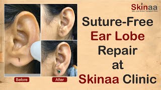 Suture-Free Ear Lobe Repair at Skinaa Clinic | Advanced Stitch-Less Ear Lobe Repair Surgery |