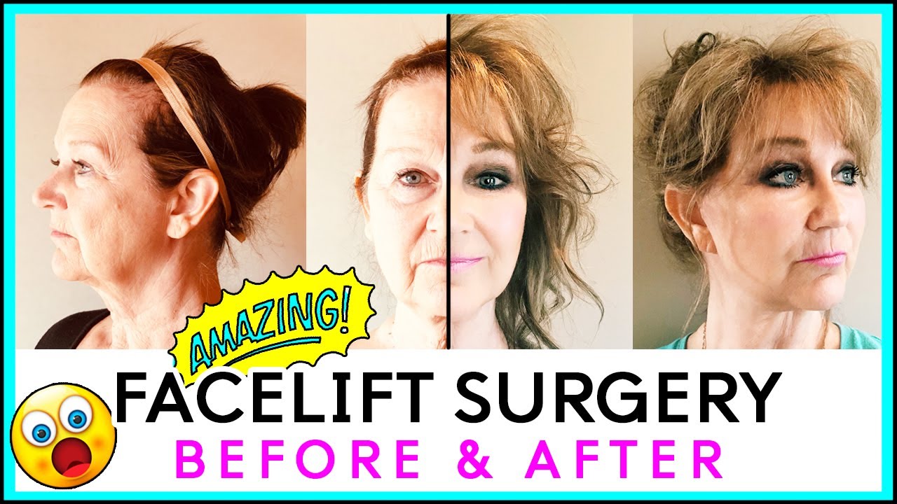 Facelift Surgery In KOREA! Pt. 2 | AMAZING BEFORE AND AFTER ...