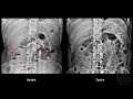 Abdominal X ray KUB Overview - RSCP Video Curriculum