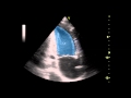 Apical Two Chamber View