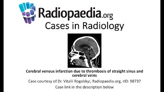 Cerebral venous infarction (Radiopaedia.org) Cases in Radiology