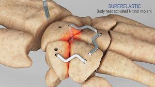 InstaFix Shape Memory Fixation System