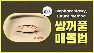 기존과 차별화된 쌍꺼풀 매몰법 어떻게 다를까요?ㅣ이상호성형외과