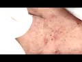 blackheads removal acne treatment and very satisfying satisfying pimple pop blackheads