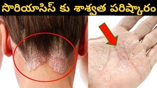 Psoriasis Treatment in Telugu || How To Get Rid Of psoriasis Naturally || psoriasis tips