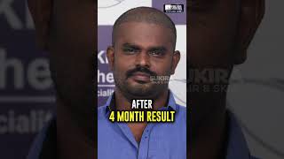 💥4 months hair transplant result 🔥Chandru HT #hairtransplant