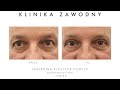 plastyka powiek czyli blefaroplastyka ~ dr n.med. piotr zawodny