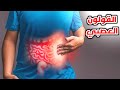 ماهو القولون العصبي؟_ What is irritable bowel syndrome