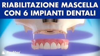 Riabilitazione mascella con 6 impianti dentali ©