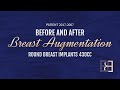 430 Round Breast Implant (Augmentation Mammaplasty) {Patient 2017-2007} Before & After